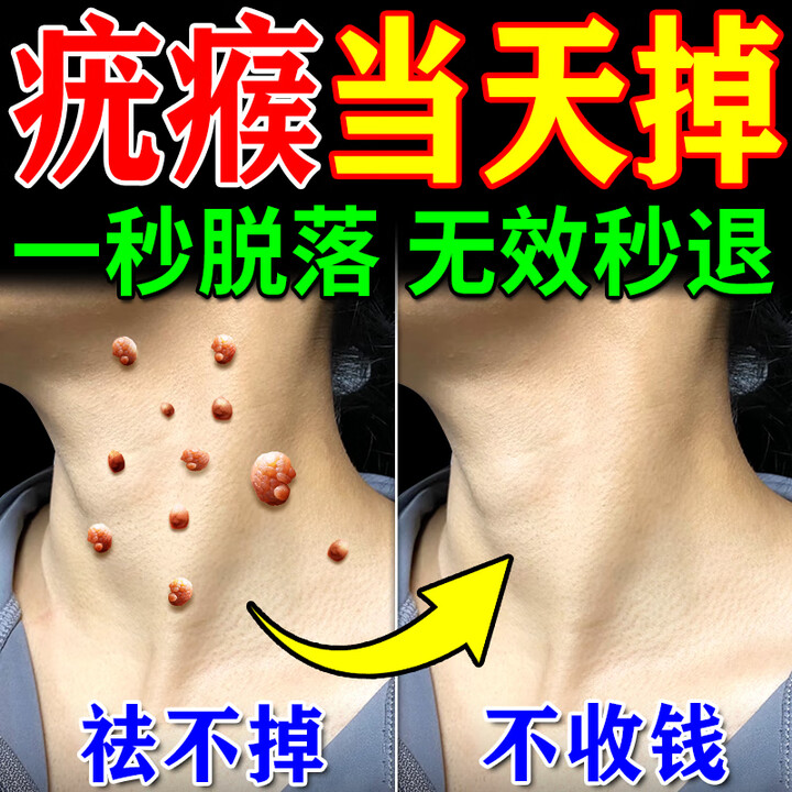 北京同仁堂去i疣灵扁平疣丝状疣面部药专用脖子上肉粒瘊子疣体脱落去除神器 1盒【去犹瘊专用膏】【图片 价格 品牌 报价】-京东
