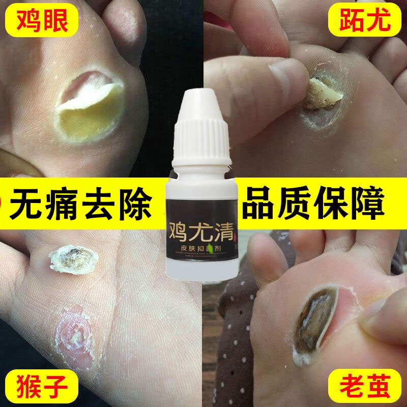 鸡眼膏贴鸡眼去除液鸡眼贴手足部去除肉刺瘊子老茧清祛疣灵必治猴子病毒寻常拓跖疣脚底趾疣止尤净液鸡眼膏液一瓶 10ml 护理 逸初生物