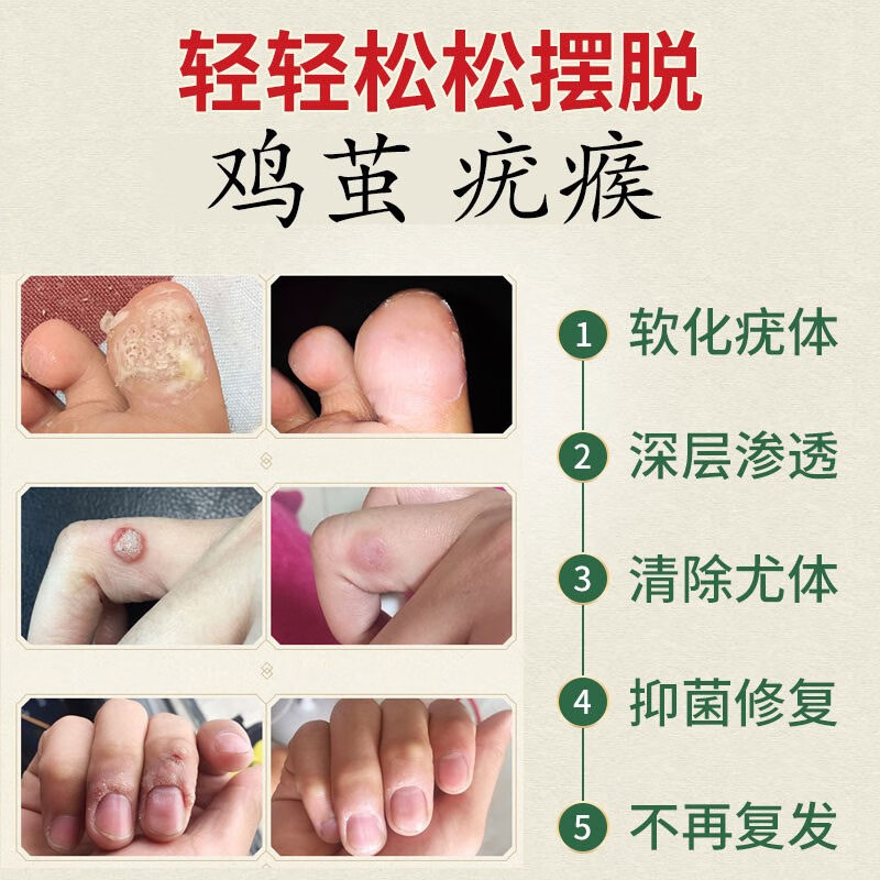 鸡眼膏贴鸡眼去除液鸡眼贴手足部去除肉刺瘊子老茧清祛疣灵必治猴子病毒寻常拓跖疣脚底趾疣止尤净液鸡眼膏液一瓶 10ml 护理 逸初生物