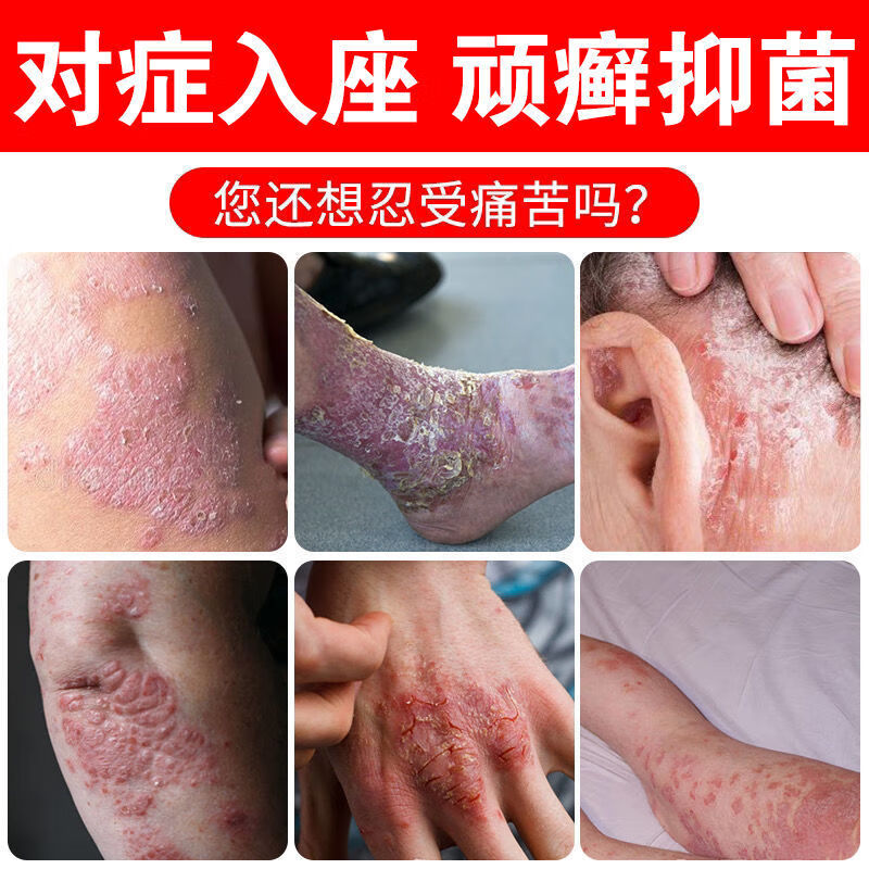 妙如莲虎毒膏银屑癣股癣头皮癣荨i麻i疹汗泡疹shi疹皮炎a-a 1瓶装