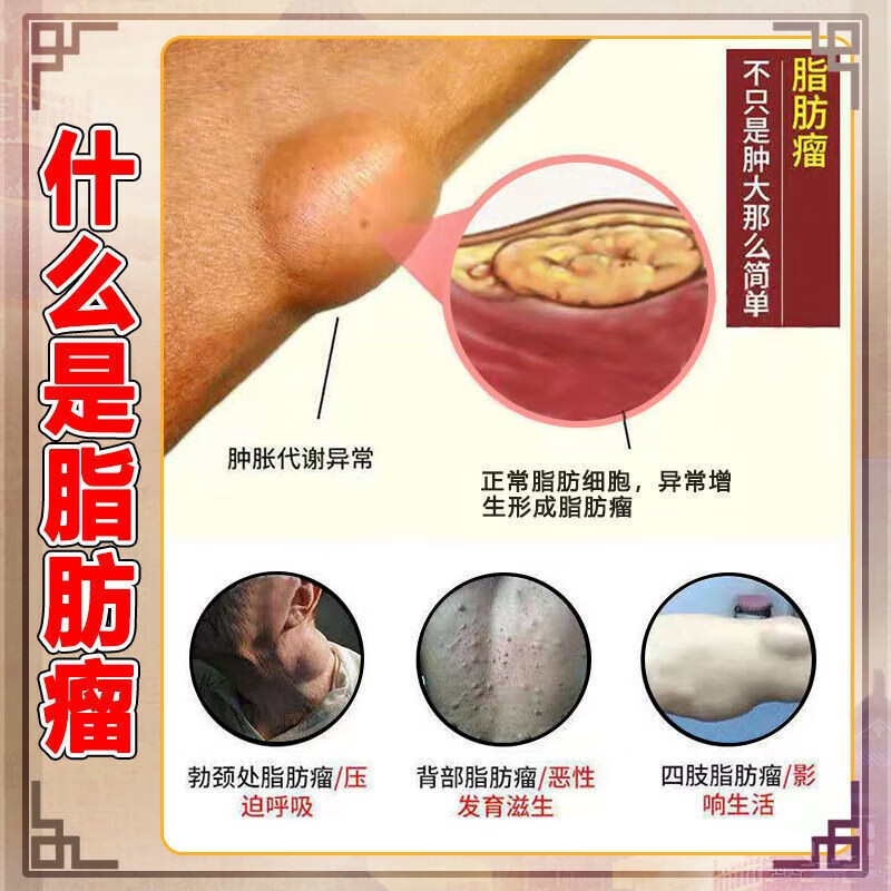 云南本草脂肪瘤膏专用脂肪康去除膏可搭配脂肪瘤贴凝胶36种皮下多发性