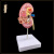人体肾解剖模型病变肾脏模型人体器官解剖模型病变内脏医院教学用 病变肾解剖模型