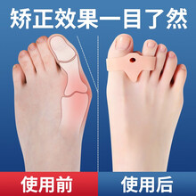 日本硅胶大脚趾拇指外翻矫正器姆外翻大脚骨纠正男女可穿鞋日夜用 肤色1双（均码）