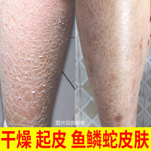 夏天手臂起皮像鸡皮肤(夏天手臂起鸡皮疙瘩是怎么回事) 夏天手臂起皮像鸡皮肤(夏天手臂起鸡皮疙瘩是怎么回事)