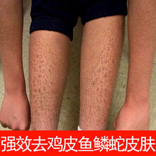 身体连续起鸡皮疙瘩(为什么全身一直起鸡皮疙瘩)