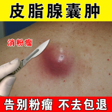 前庭大腺囊肿 商品搜索 京东 前庭大腺囊肿 商品搜索 京东