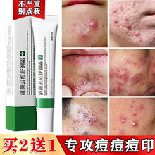 【草本祛痘膏】痘肌痘坑痘疤淡化痘痘修复祛精华痘印凝胶痘印芦荟胶产品去套装液男女学生青春痘痤疮粉刺面霜 一支装(体验装)