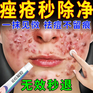 天池七草祛痘消焱青少年痤疮专用乳膏青春痘粉刺硬疙瘩修复消焱去除痘印 W 一盒装【一抹见傚】