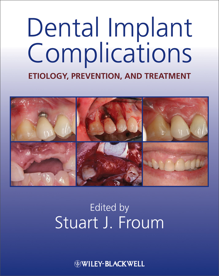 dental implant complications: etiology, prevention, and