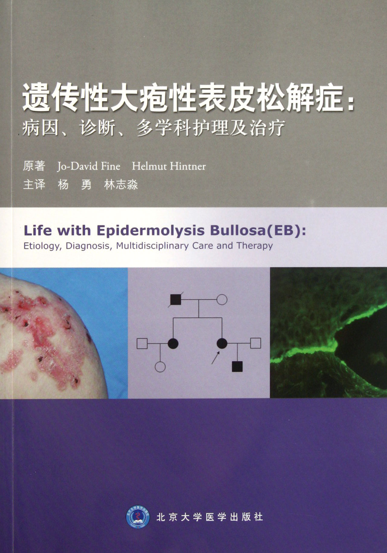 遗传性大疱性表皮松解症--病因诊断多学科护理及治疗