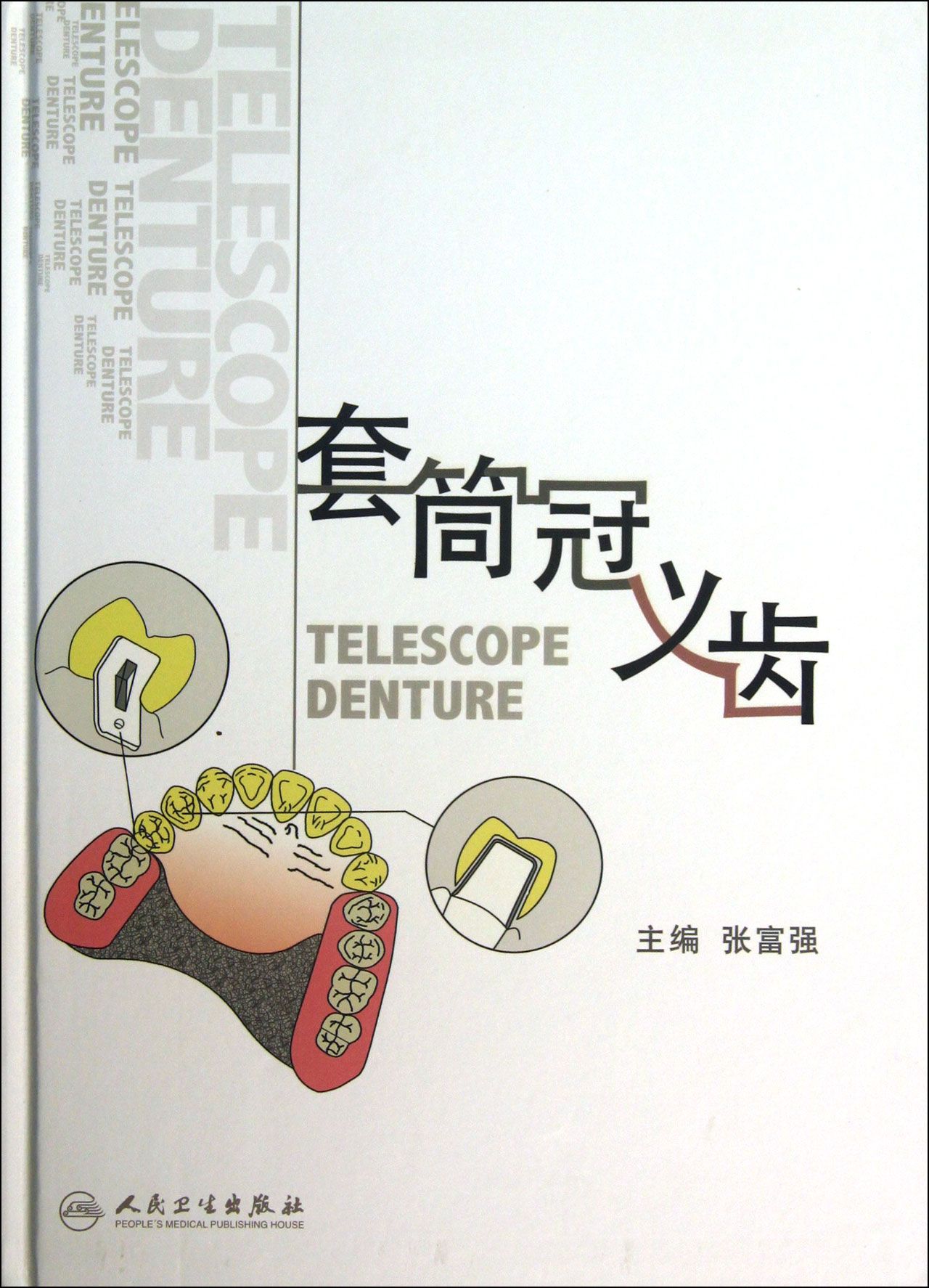 套筒冠义齿(精)