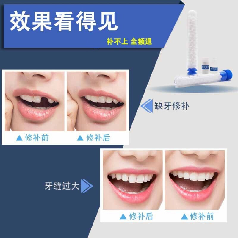 阙时翊 自己补牙自制临时假牙套牙临时牙套老人假牙门牙套牙缝牙洞材料 可做5颗牙