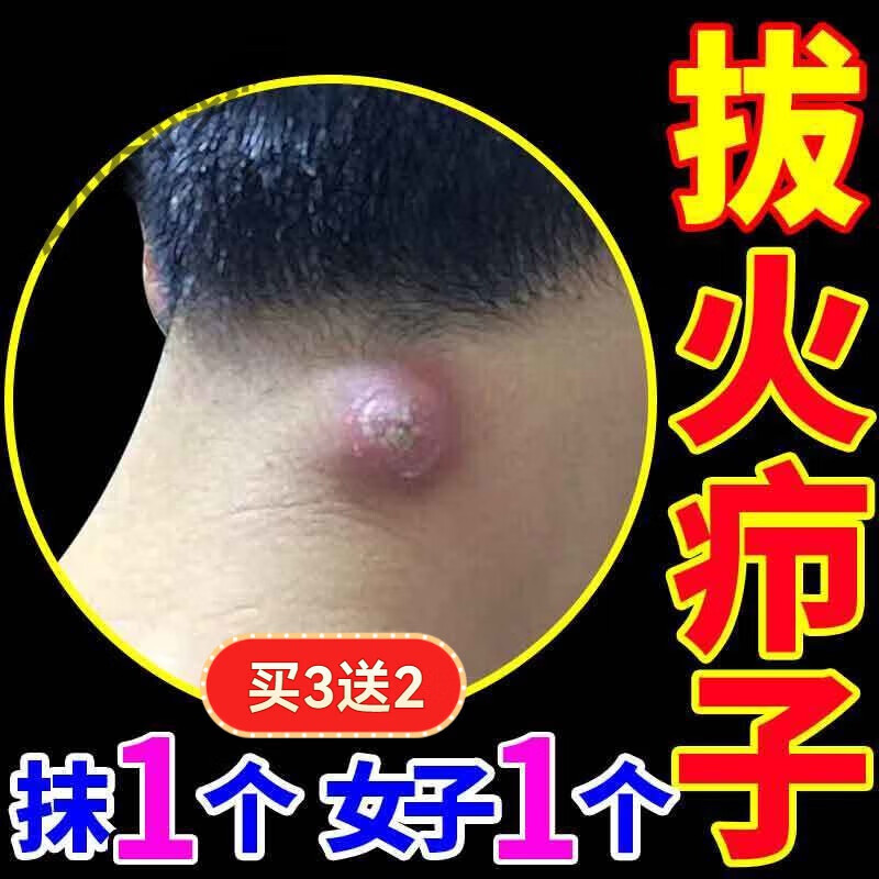 熏姿颜idgc乳膏拔毒膏治火疖子屁股坐板疮肿硬块药祛浓疮包毛囊 5支