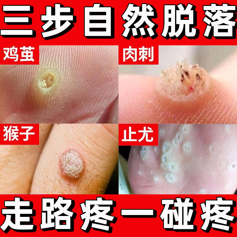 鸡眼膏 去i根肉刺药膏无痛脱落鸡眼贴特专用效药去成人根去肉刺刺猴无
