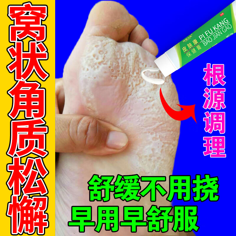 窝状角质松懈症脱皮烂脚丫窝状角质松解症起泡脚底烂脚角质型脚臭脚痒