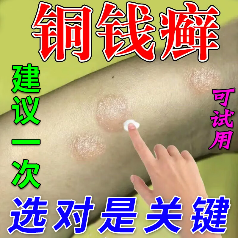 牛皮癣专用特傚效中药顽固牛皮癣银屑膏病治疗断i根牛皮癣药i膏真菌