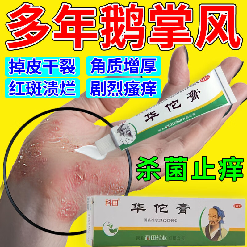 手癣真菌感染药膏】鹅掌风专用药开裂脱皮手癣真菌手上起小水泡手痒
