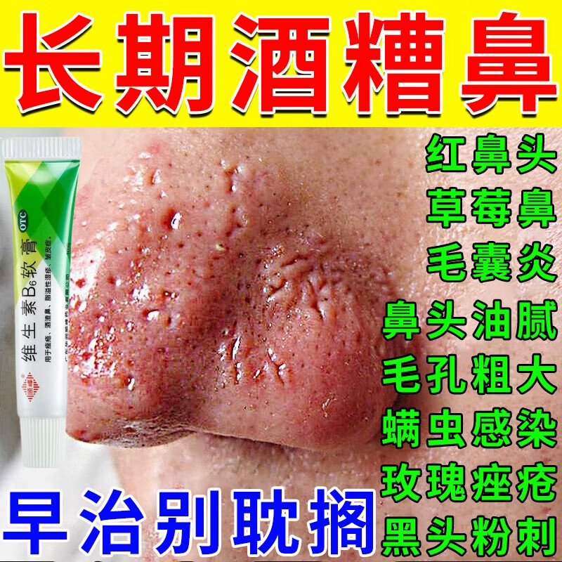 酒糟鼻专用药膏修复红鼻子草莓鼻黑头粉刺 酒渣鼻鼻头除螨虫痤疮鼻头