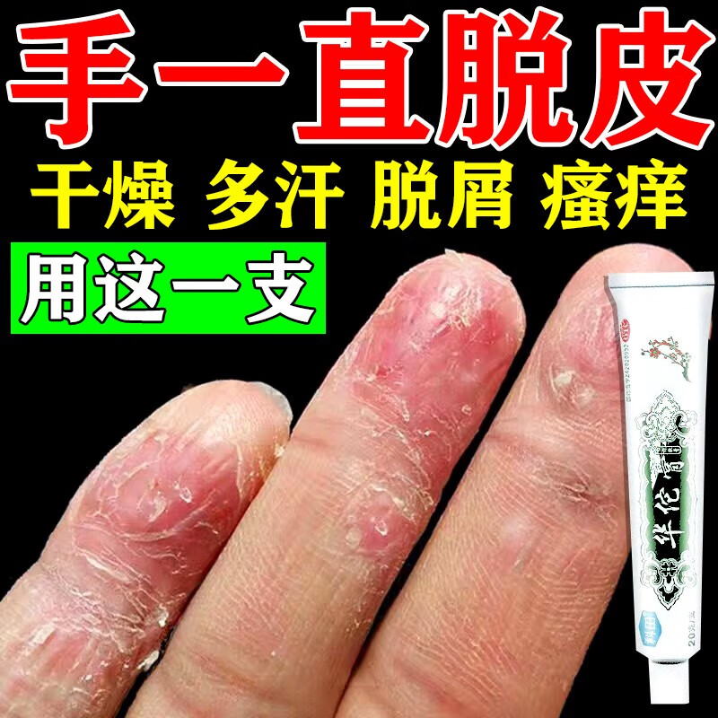 治干裂脱皮手癣膏鹅掌风药膏手掌粗糙变厚脱皮开裂真菌感染用药脱屑