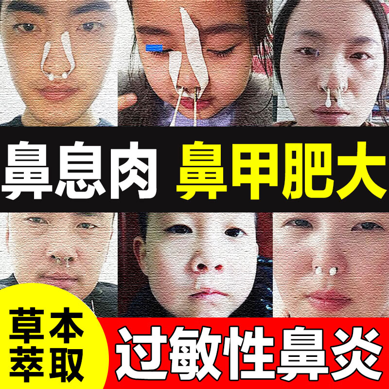 鼻甲肥大鼻息肉脱落流鼻涕鼻塞鼻炎鼻子快速不通气成人儿童鼻窦炎过敏