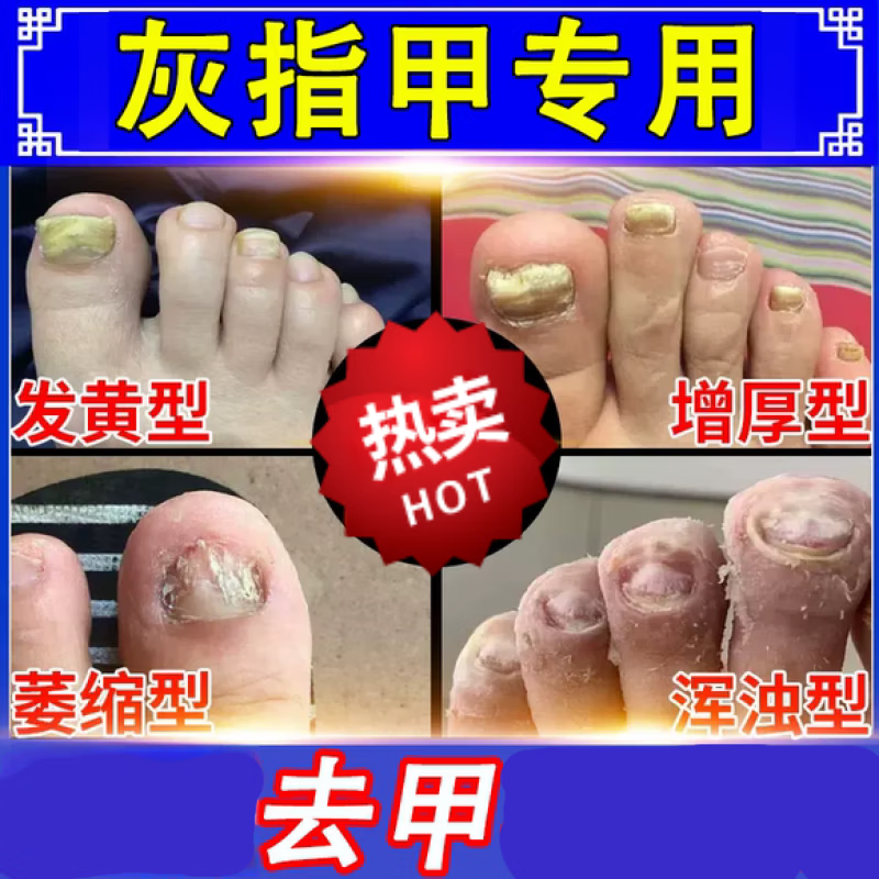 冰醋酸溶液 灰指甲华山医院外用灰指甲厚甲真菌感染稀释泡脚高浓度灰