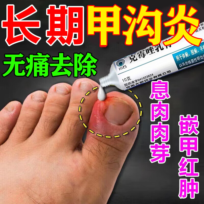 甲沟炎专用药治甲沟炎药膏消肿专用药去肉芽指甲长肉里红肿疼痛脚指甲