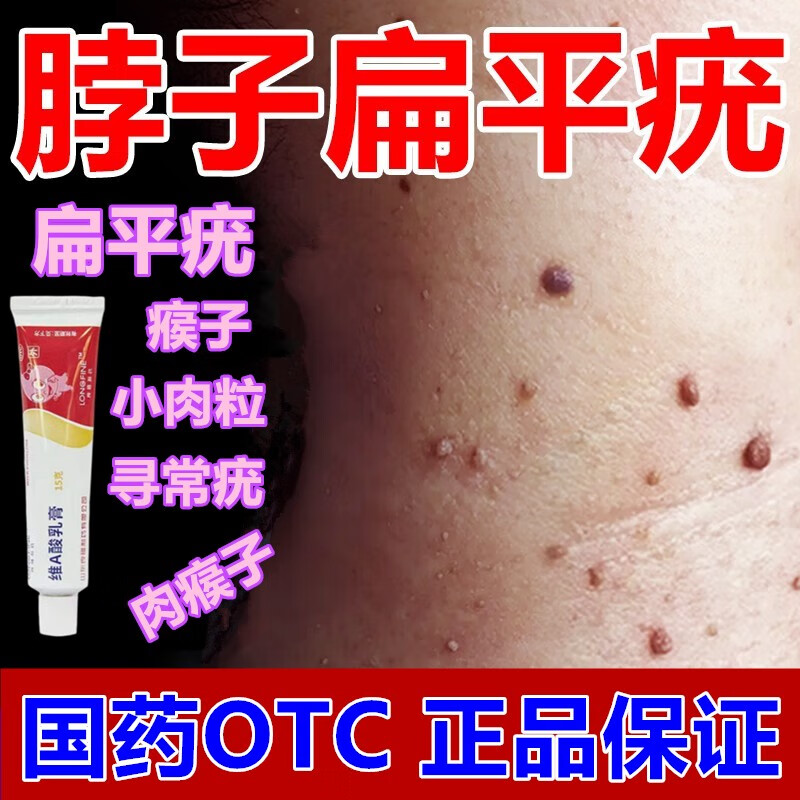 维a酸乳膏 扁平疣药膏 去看看猴子扁去看看疣灵扁平疣面部脖子瘊子