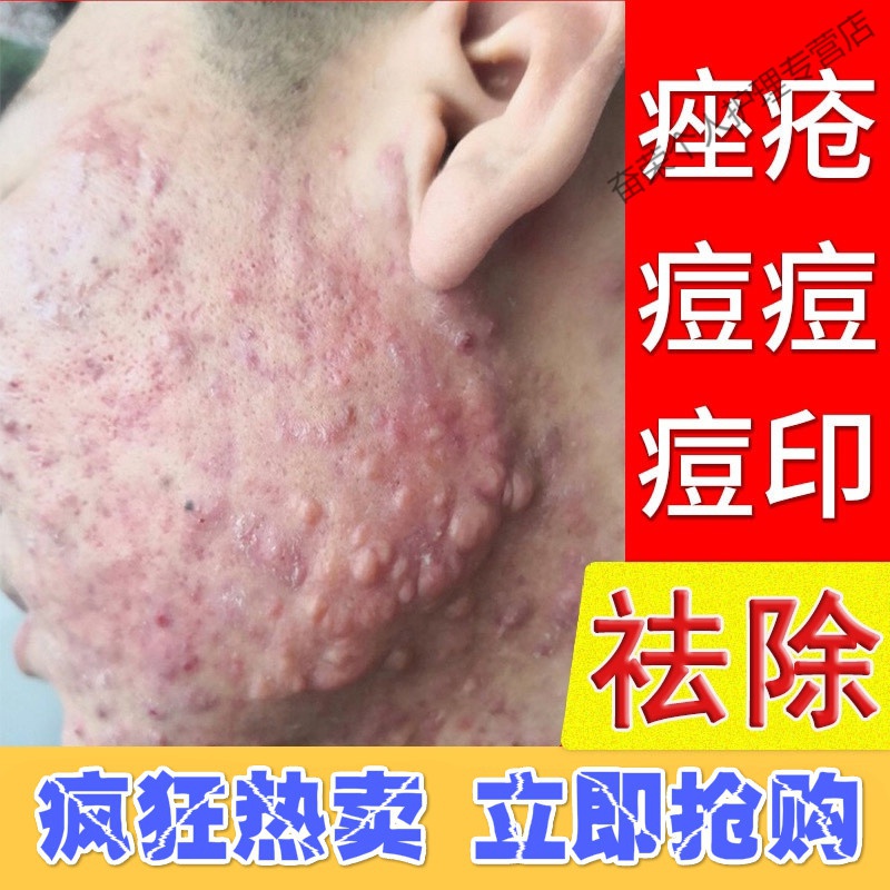 修复痘印訷器座暗疮男女痤i疮膏祛痘重度脸上长痘痘怎么办红肿痘坑