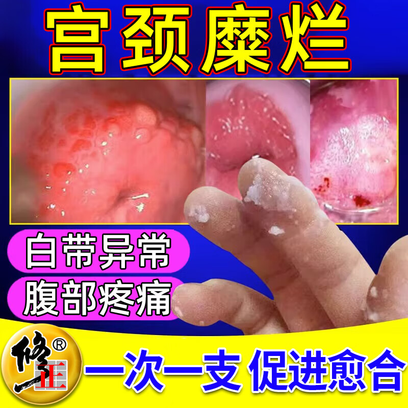 修正 宫颈糜烂阴道炎宫颈炎妇科炎症霉菌性阴道炎白带异常疼痛血样脓