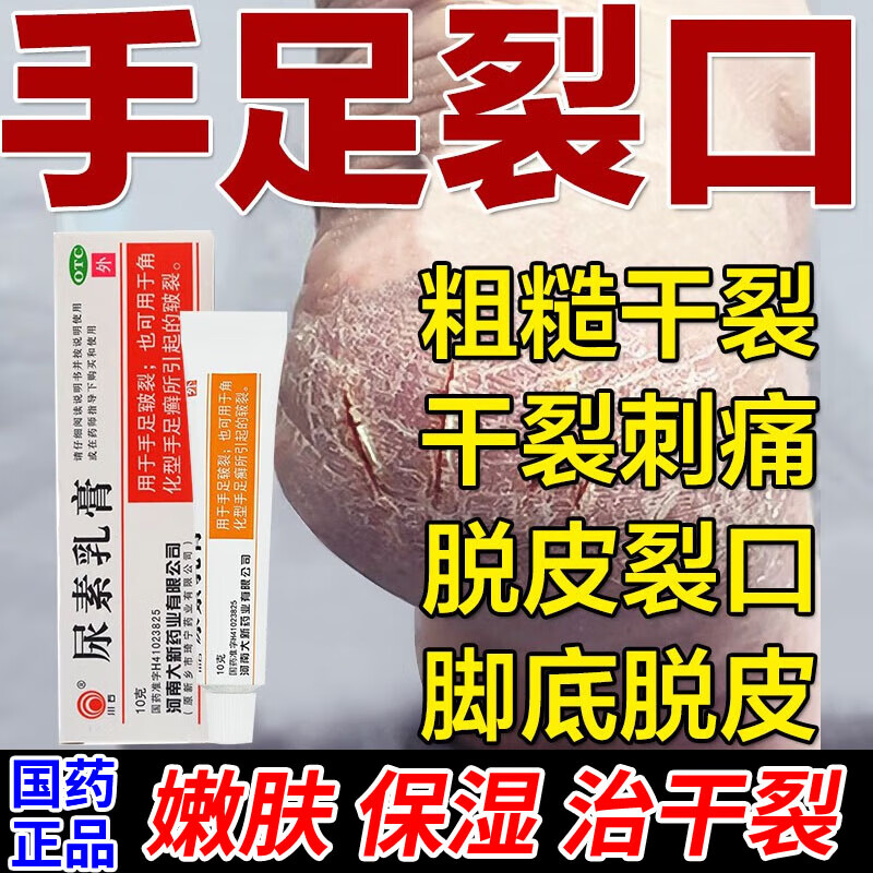尿素乳膏 治手脚皲裂角化型手足癣引起干裂粗糙裂口疼脱皮去角质手裂