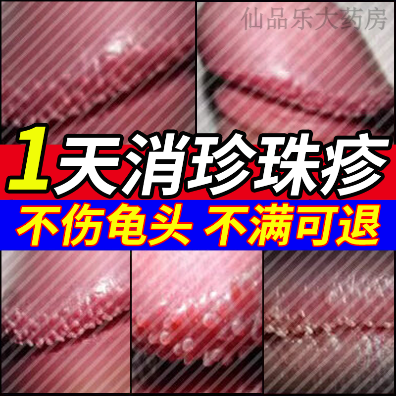 修正珍珠疹去除男性冠状沟珍珠疹专的用药珍珠丘疹去除龟头白点冠状沟