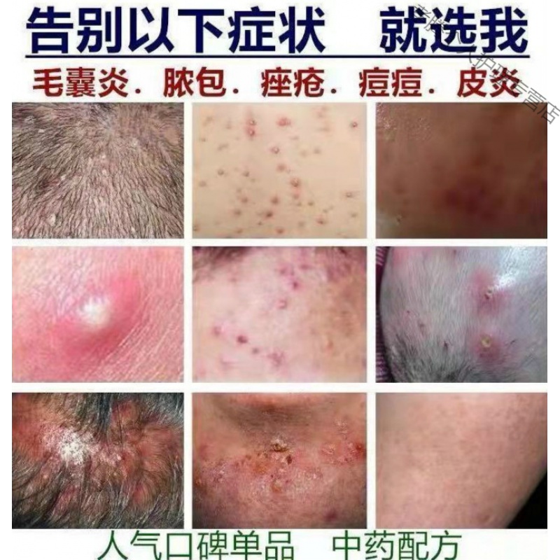 毛囊炎箹l膏治头部脸部背部胸部毛囊炎痘痘脓包痤l疮皮肤瘙痒止痒膏