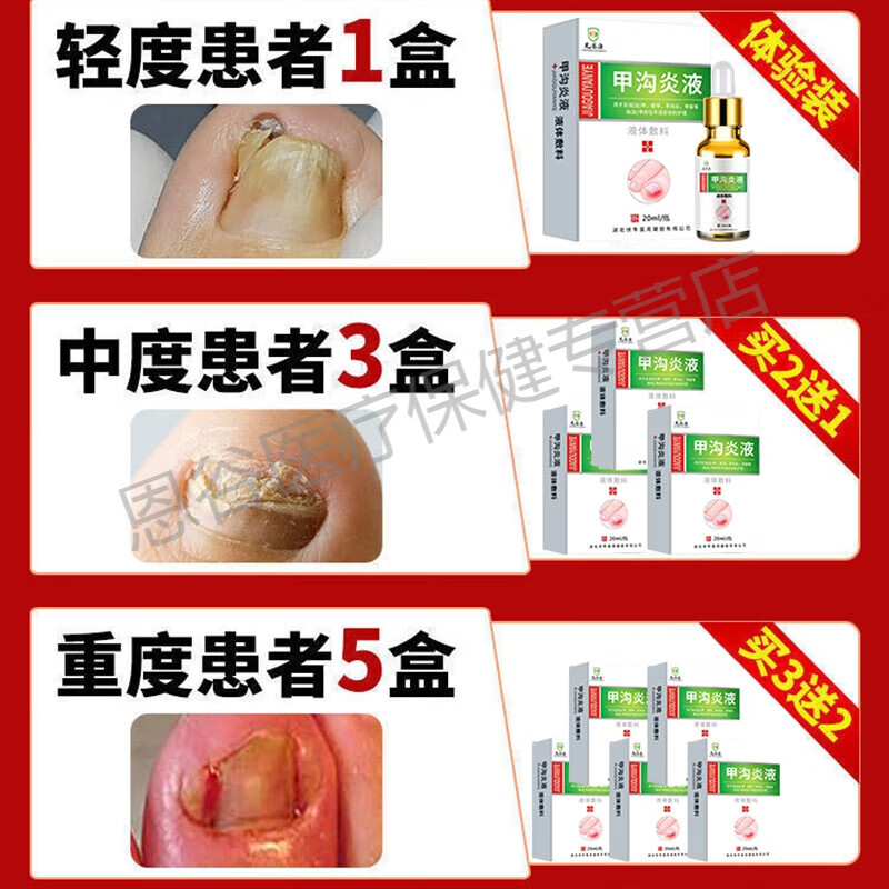 药房直发 甲沟炎消肿去肉芽 甲沟炎专用软甲消肿去肉芽嵌甲治療手指