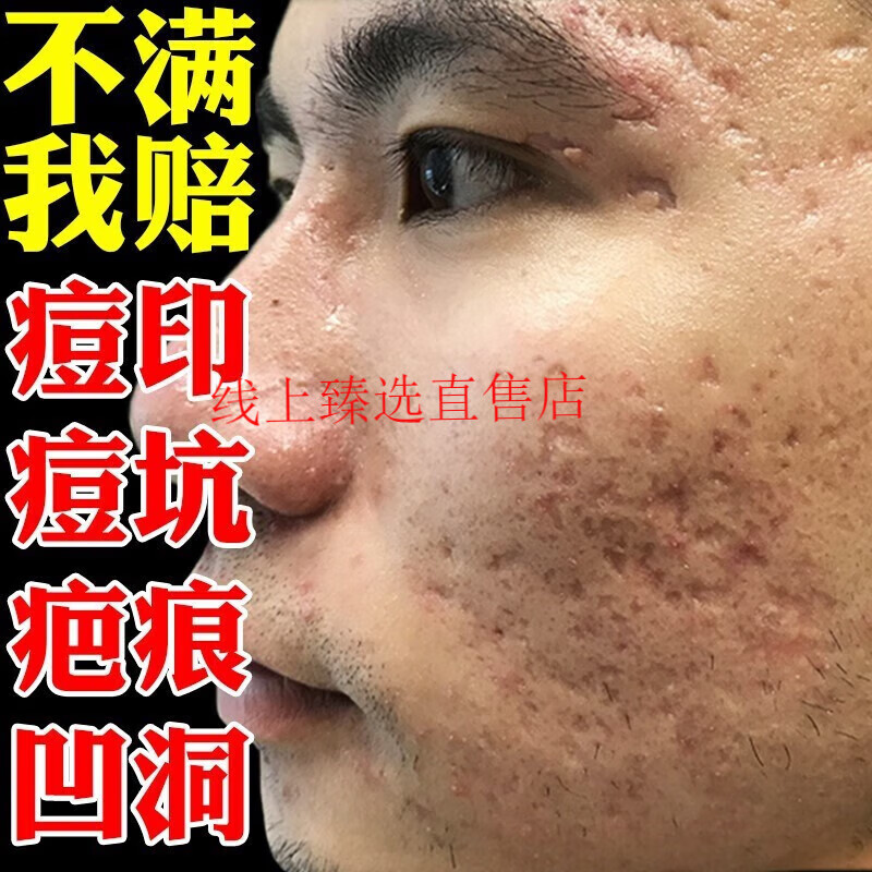 淡化痘痕面部妊娠疤面部烫伤疤痕膏 一盒体验装(轻微较浅痘印使用)