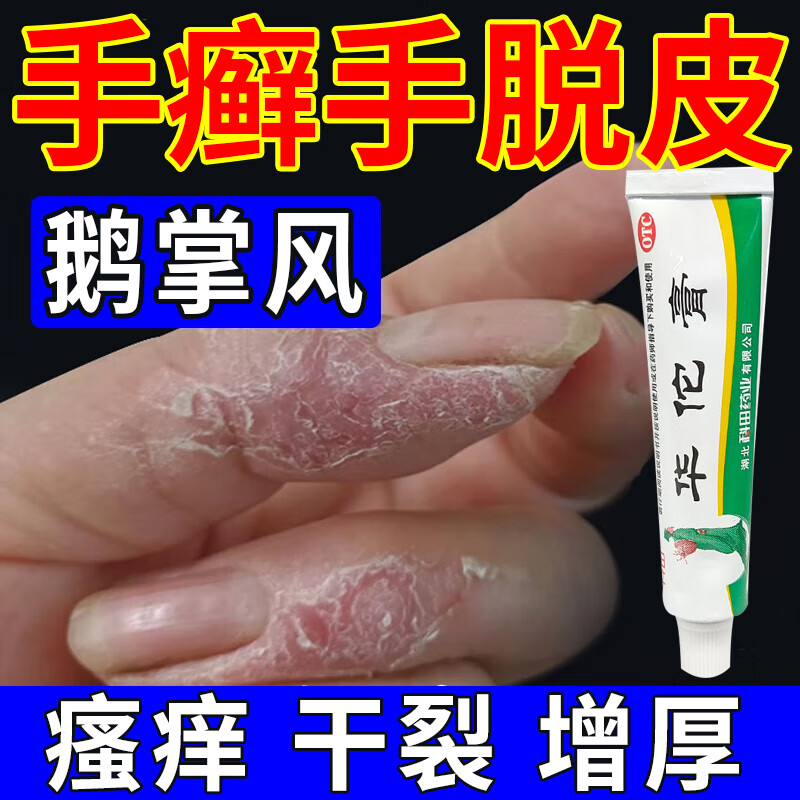 治鹅掌风药膏手干裂脱皮手掌粗糙变厚脱皮瘙痒手癣真菌感染开裂水泡