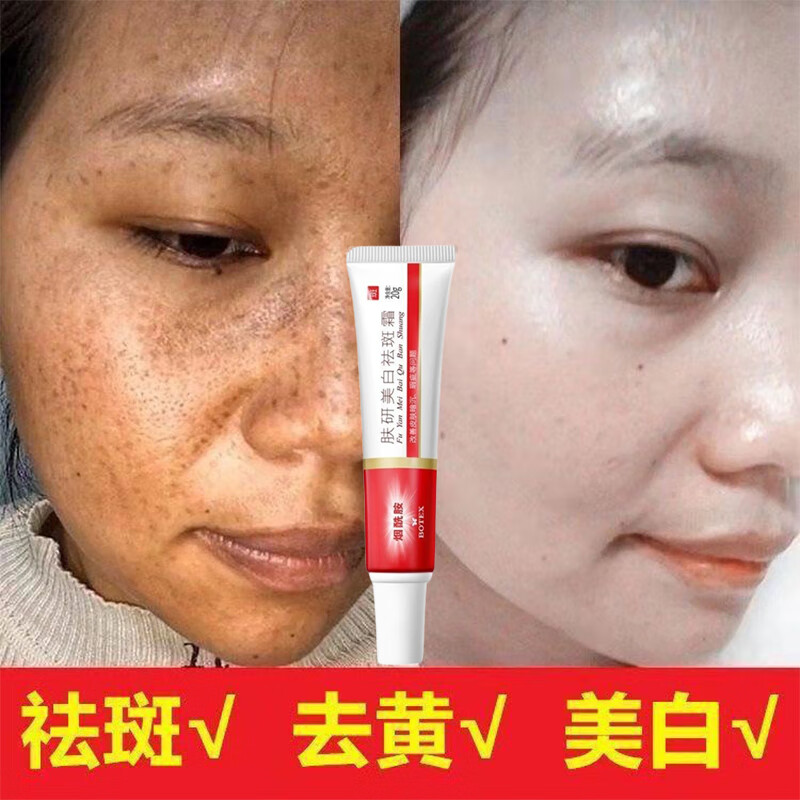 黄褐斑 祛斑霜祛老年斑去雀斑品正手部脸部手背专用的药强力去除