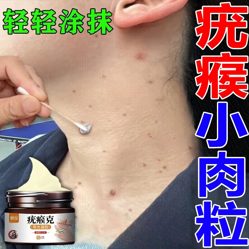 小肉粒去除膏扁平疣疣瘊专用膏 去i疣灵去除脖子上长小肉粒疙瘩皮赘
