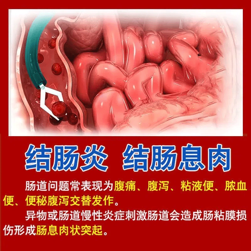 结肠贴 肠炎结肠炎腹泻腹痛拉肚子肚脐贴慢性结肠炎调理修复液肠胃贴结肠贴 单盒装【6贴】