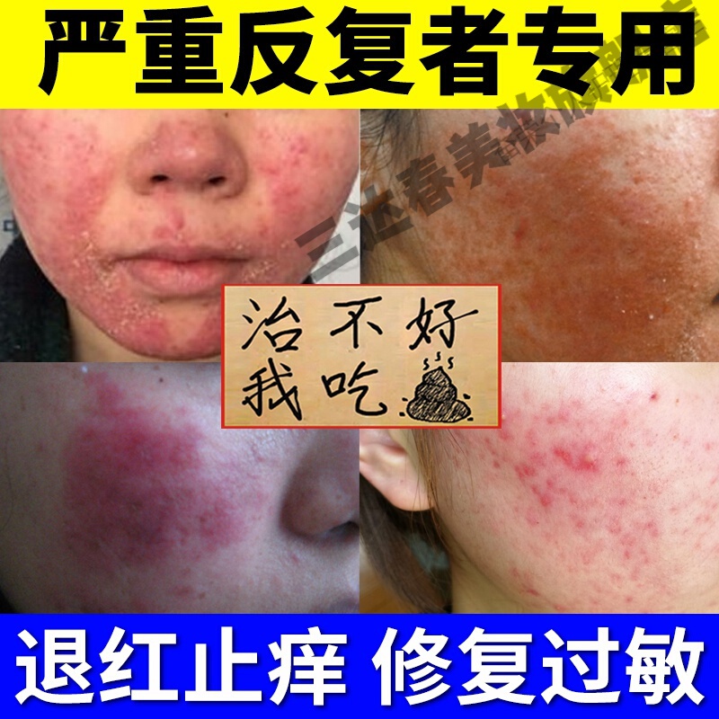 紫外线过敏皮肤修复脸部止i痒膏脸上专用箹面部干燥脱皮泛红肿痒霜