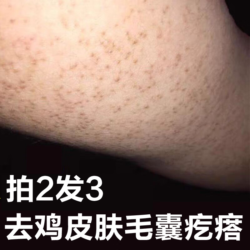 产后小腿变鸡皮肤(产后皮肤粗糙像鸡皮肤) 产后小腿变鸡皮肤(产后皮肤粗糙像鸡皮肤)