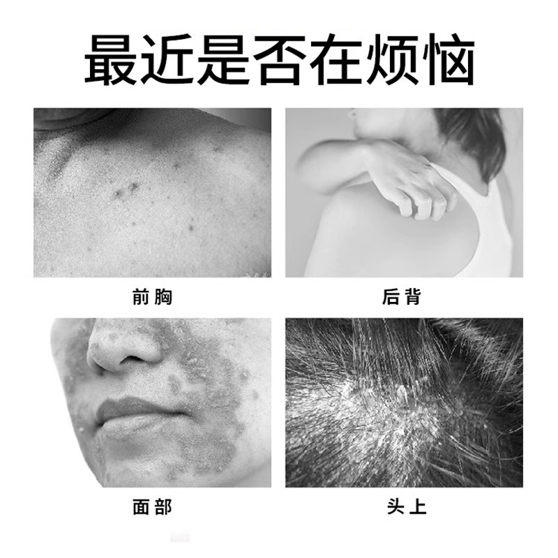 复方氯霉i素洗剂氯霉i素搽剂头部水杨酸酊乙醇酒精溶液水氯酊氯林 1瓶