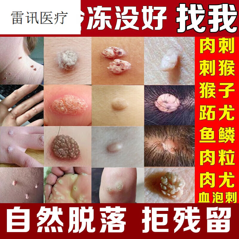 【京健康】子的药点取手上长猴子脖子小肉粒鱼鳞痣贴血泡肉刺猴跖