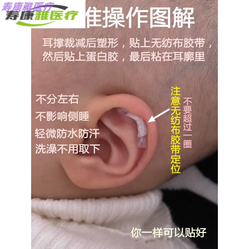 耳廓矫正器固定 单耳婴儿垂耳折耳廓矫形器可塑形招风耳朵矫正器康复