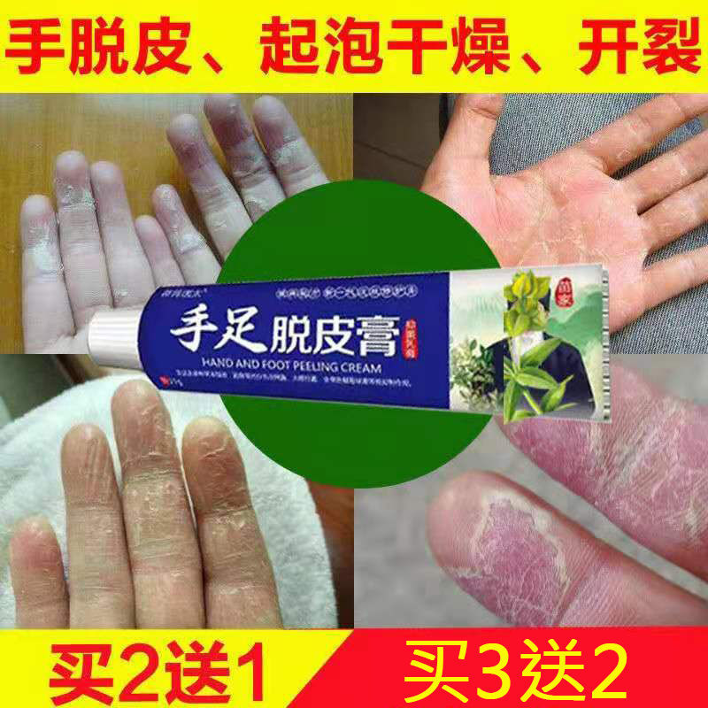 儿童手指脱皮膏反复蜕皮开裂起水泡手痒季节性脱皮真菌感染修复霜