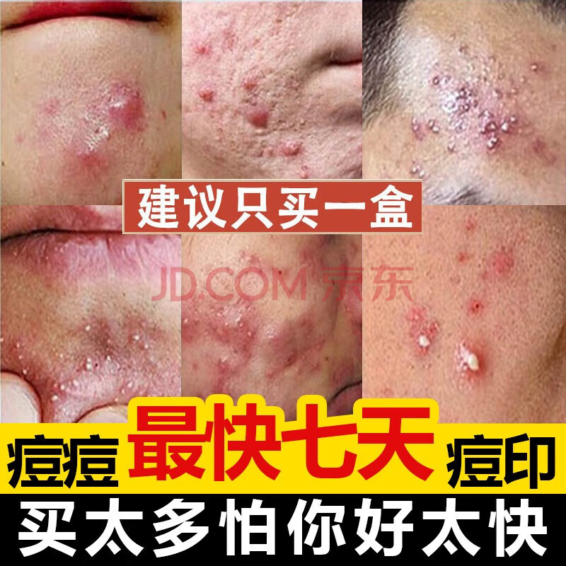 芙迪祛痘印痘坑草本痘膏熬夜长痘青春痘粉刺痤l疮暗疮痘肌面部清洁膏 
