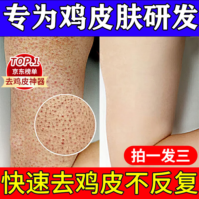 鸡皮肤疙瘩毛囊角化症专用草药儿童成人鸡皮肤去除喷雾去鸡皮肤毛囊