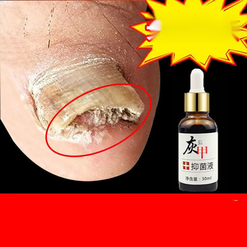 灰指甲液发黑分离增厚灰甲亮甲脱甲膏喷剂 超大容量【一盒装】