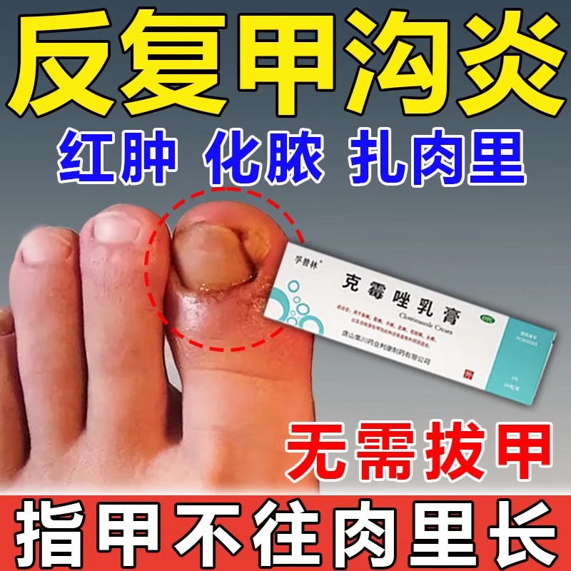 治甲沟炎 甲沟炎成人专用药 甲沟炎成人专用药治甲沟炎药膏  皮肤用药