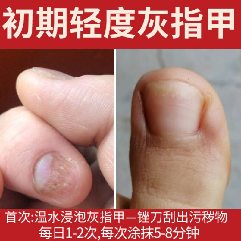灰指甲灰指甲专用中液辅助增厚型脚趾脱甲膏冰醋酸软甲净 【轻度灰