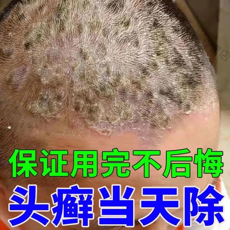 好用可退】牛皮x癣头皮脂溢性皮p炎头皮毛囊炎* 三盒装【3个月内症状